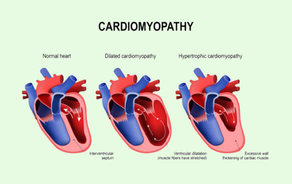 Hereditary Cardiomyopathy