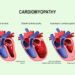 Hereditary Cardiomyopathy